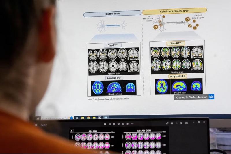 ابتكار منظومة ذكاء اصطناعي لقياس البصمة الجينية لأورام المخ أثناء الجراحة